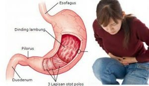 Ini Tips Cegah Penyakit Maag