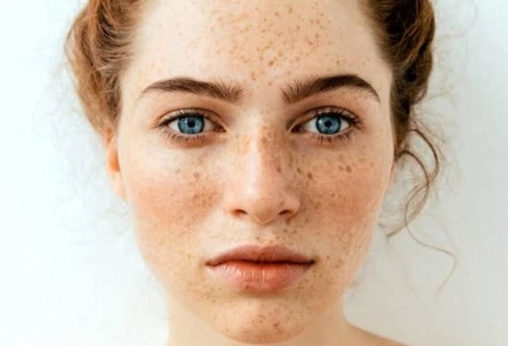 Cara Atasi Flek Hitam Pada Wajah Cantikmu