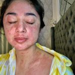 Terpapar COVID-19 Pedangdut Dewi Persik Alami Gejala Ruam