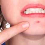 Lima Cara Menghilangkan Jerawat Batu Tanpa Sakit