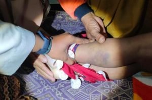 Bocah Perempuan Meninggal Dengan Penuh Luka Memar Diselidiki Polisi