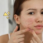 Jerawat di wajahmu, Berita tips